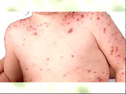 Programa de erradicación de la viruela.