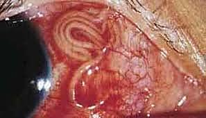 Programa de Lucha contra la Oncocercosis.