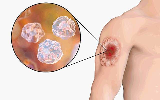 Resolución para eliminar Lepra.