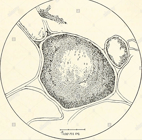 Material de la enfermedad