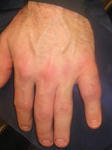 The first bone I ever broke.