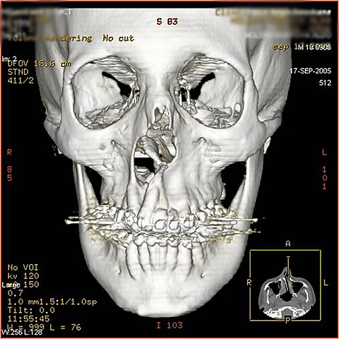 Codificación espacial de la señal