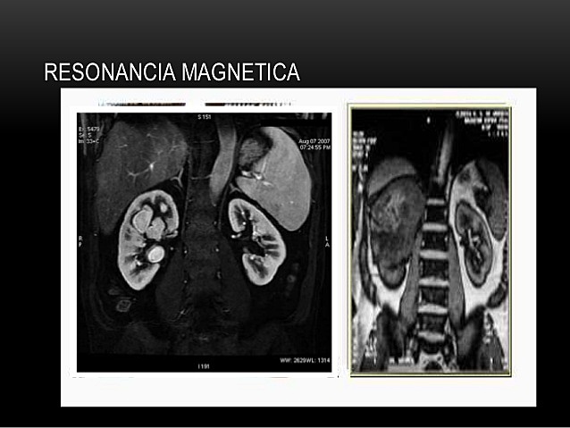 DIFERENCIAS EN LOS ESPECTROS RM EN TUMORES DE HIGADO Y RIÑON