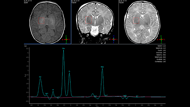 La espectroscopía por RM