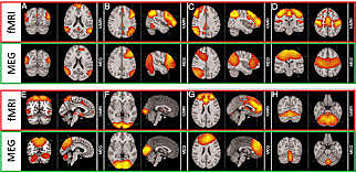 Magnetoencefalografía