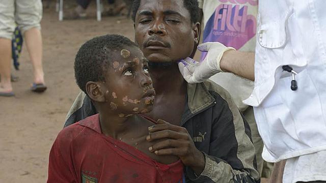 Lanzamiento del programa mundial de lucha contra el pian