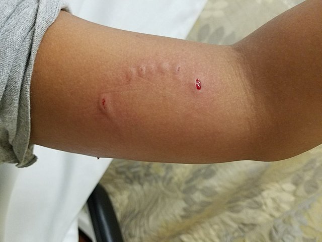 I got bit by my own dog