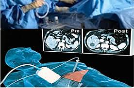 “RESONANCE ABSORPTION BY NUCLEAR MAGNETIC MOMENTS IN A SOLID DE PURCELL ET AL Y “NUCLEAR INDUCTION”