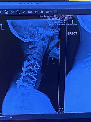 Spine surgery