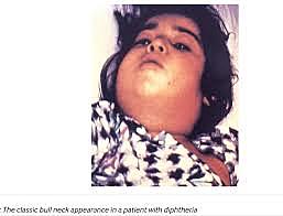 brote de difteria en la union soviética