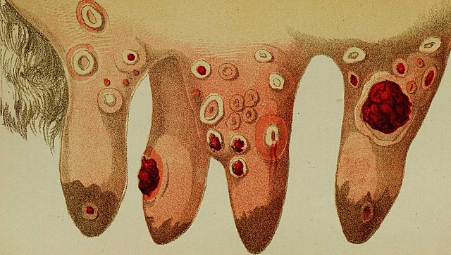 Benjamin Jesty: variolización