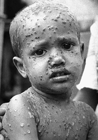 Niño afectado por viruela.