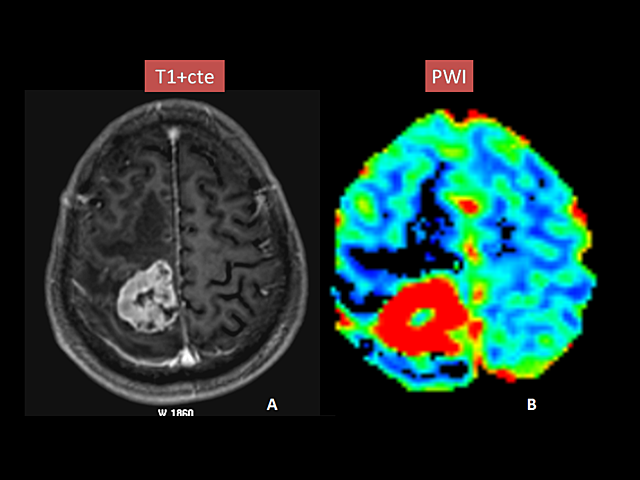 Se desarrolla la técnica Ecoplanar para explorar el cerebro en segundos.