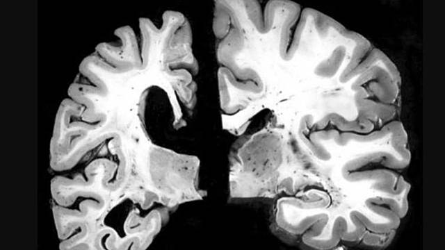 Primeros tratamientos para el Alzheimer