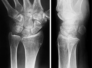 The day I broke my arm