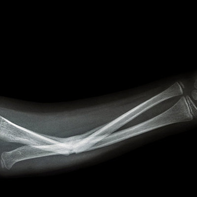 Timeline: The Day My Brother Broke My Arm