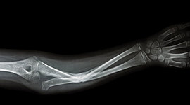 Timeline: The Day My Brother Broke My Arm