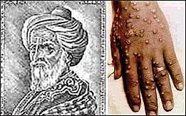 Al Rhazes discovers the difference between smallpox and measles