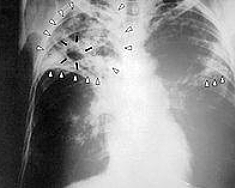 Tuberculosis