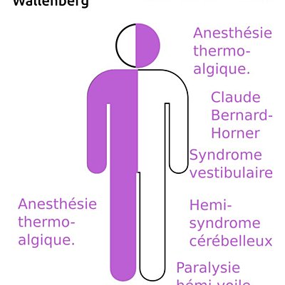 Timeline: Caso clínico Síndrome de Wallenberg