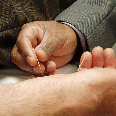 100 BCE - ACUPUNTURA