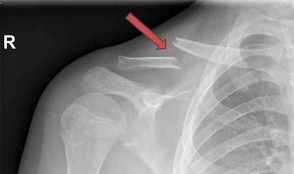 Schlüsselbein Gebrochen