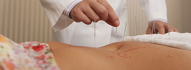Acupuntura