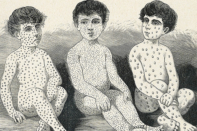 difference between measles and smallpox