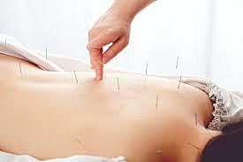 100 A.C  BCE Acupuntura