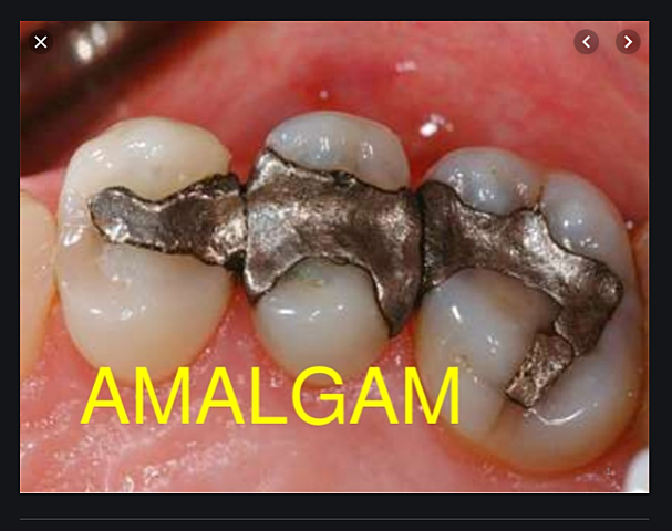 Amalgam