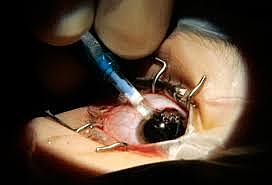 First Successful Eye Surgery