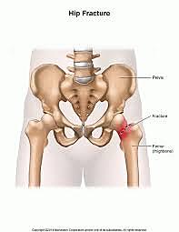 Hip Bone Fractures