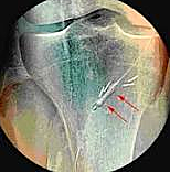 Balloon Embolectomy Catheter