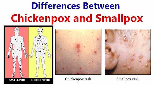 Difference between small pox and measles