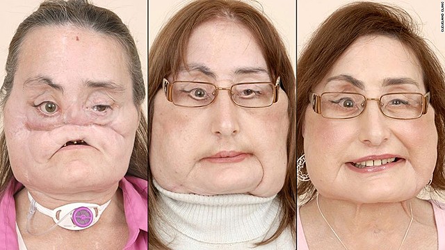 Face Transplants