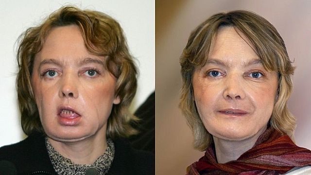 Face Transplant
