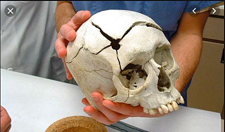 Forensic Anthropology