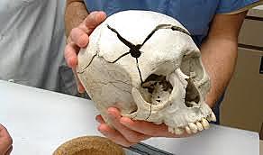 Forensic Anthropology