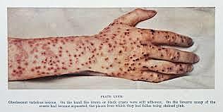 Smallpox and Cowpox