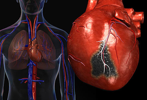Heart disease deaths drop by 40 Percent