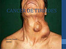 Cancer de Tiroides