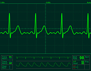 ECG\EKG