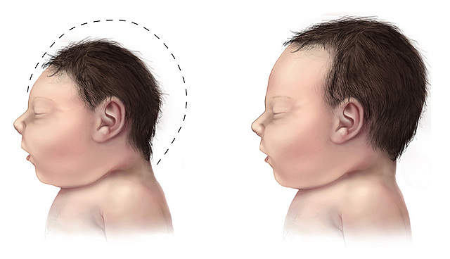 The second defect: Microcephaly