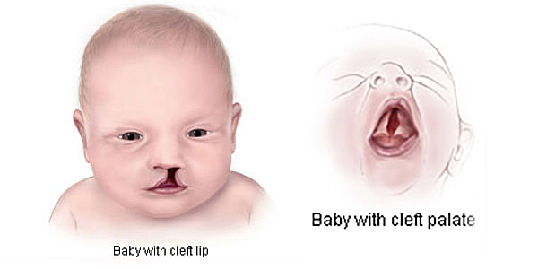 The third defect: Cleft lip and cleft palate.