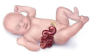 The fourth defect: Gastroschisis.
