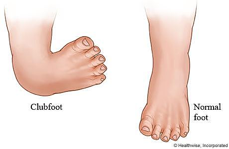 The fifth defect: Clubfoot.