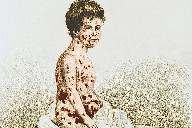 Small pox vs measles
