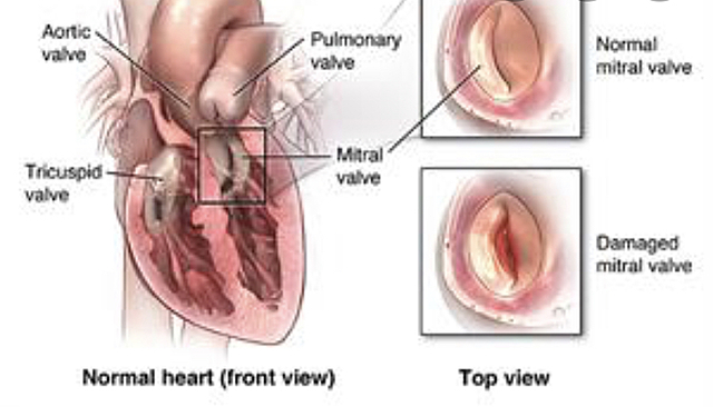 heart valve surgery