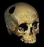Trepanning