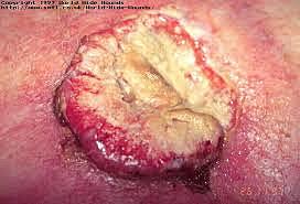 steve thomas used sterile maggots for infectious wound treatment